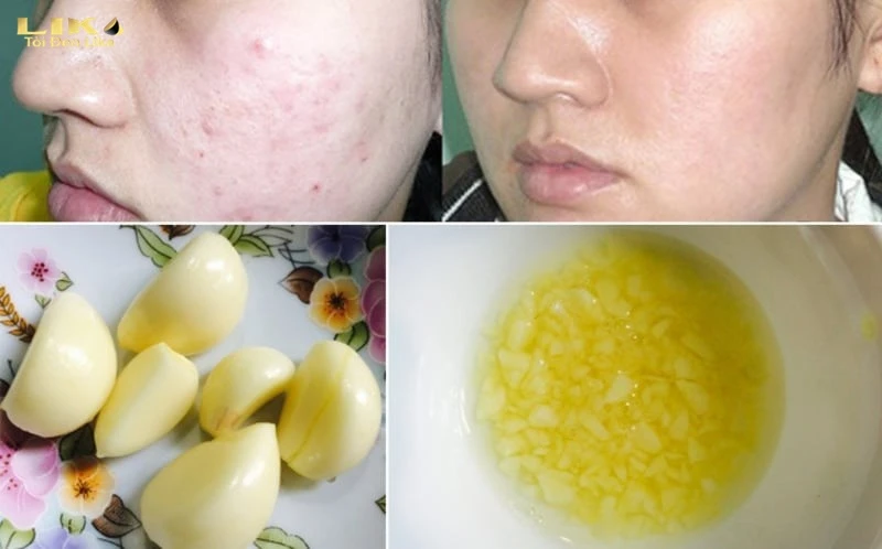Tinh dầu tỏi hỗ trợ làm giảm mụn