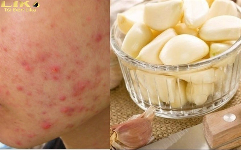 Cần chú ý cách trị mụn bằng tỏi để tránh các rủi ro không đáng có