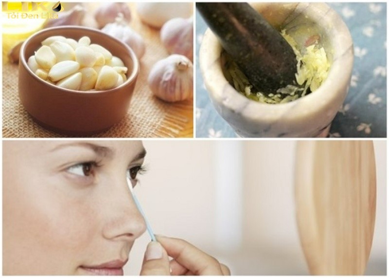 Các cách trị mụn bằng tỏi chỉ nên áp dụng tối đa 3 lần/tuần